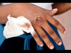 Deniesha Maxwell shows the bite she received on her hand from one of the dogs.