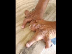 Holmes’ abnormally shaped hands.