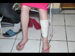 Stephanie Edwards Ellis shows her bandaged leg.