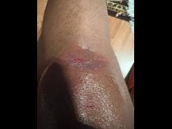 The injured leg of the student. 