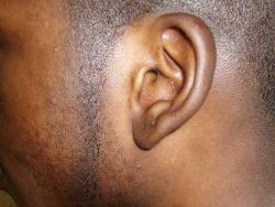 Bleaching can cause damage to the skin as is seen here.