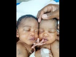 Conjoined twins Azora and Azaria Elson.