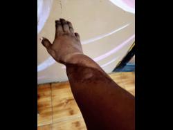 Simone Morgan shows her disfigured arm.