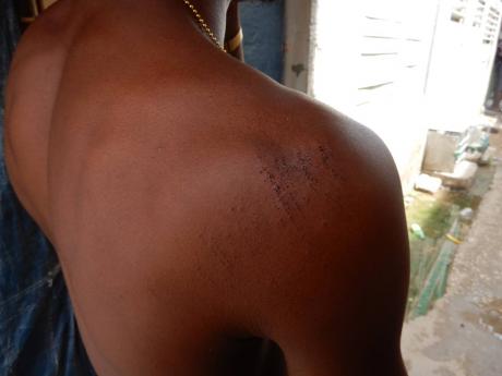 Abrahams also showed bruises to his shoulder.