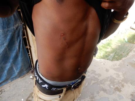 Abrahams shows bruises to his upper body.