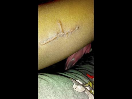 Credit: Contributed The implants placed under Angel Ricketts’ skin.