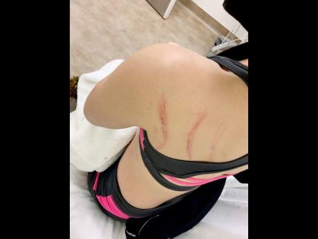 Samantha J showing the bruises on her back.