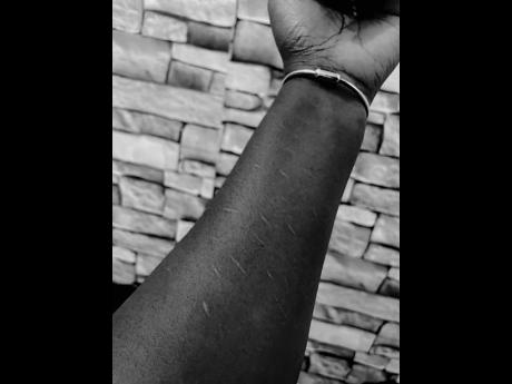 Credit: Contributed These scars on Chala Suzie McNee’s arm are testimony to the many times she has harmed herself.