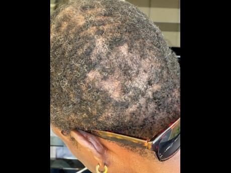 Thompson says though his scar is barely visible, it causes tremendous pain on a daily basis. 