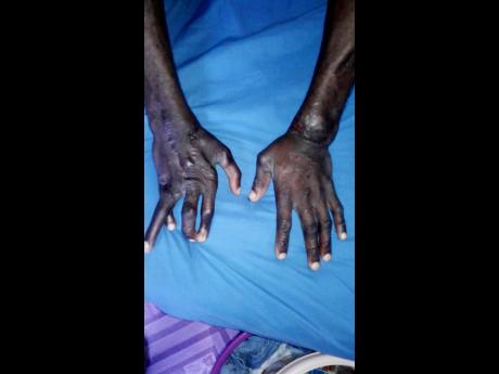 Credit: Contributed Christopher Perkins shows his badly disfigured hands.