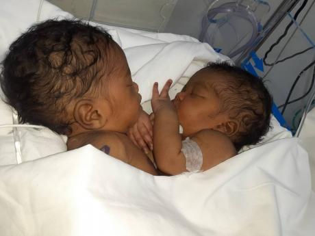 Despite Azora’s health issues, the twins continue to defy the odds.