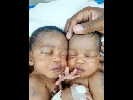 Conjoined twins Azora and Azaria Elson, while they were still patients at the UHWI.