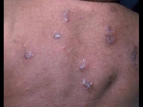 Visible evidence of the harsh skin infection that Pansy Henry said she contracted in police custody.